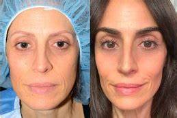 Expert Alopecia and Hair Loss Treatments in Dubai at Cosmocare Medical Center