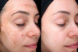 Expert Facial Skin Treatments in Dubai at Cosmocare Medical Center