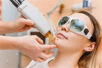 Facial Wart Removal Specialist in Dubai at Cosmocare Medical Center