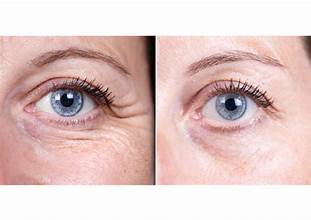 Botox Before After