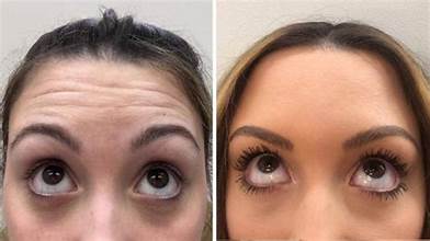 Botox Before After