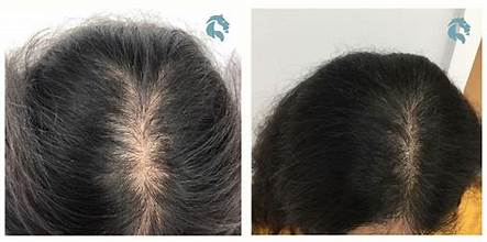 PRP Therapy