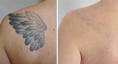 Tattoo Removal