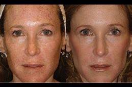 Large Pores Treatment in Dubai by Dr. Murtuza Bandukwala at Cosmocare Medical Center