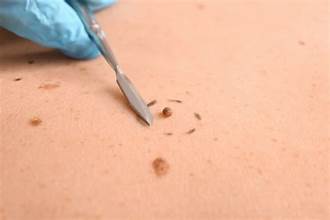 Laser Wart Removal Specialist in Dubai at Cosmocare Medical Center