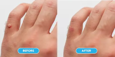 Laser Wart Removal Specialist in Dubai at Cosmocare Medical Center