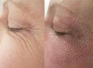 Plasma Lift Treatment in Dubai by Dr. Murtuza Bandukwala - Cosmocare Medical Center