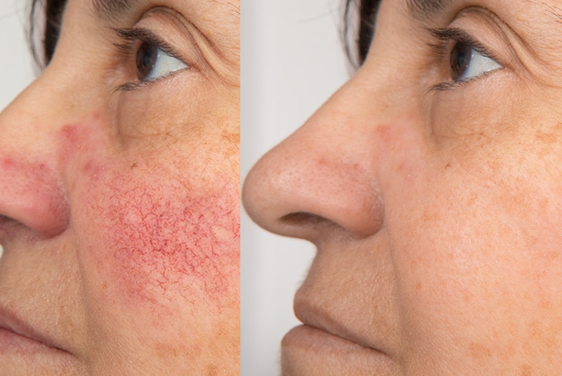 Expert Rosacea Laser Treatment and Skin Care in Dubai at Cosmocare Medical Center