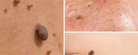 Expert Skin Cancer & Mole Removal Treatments in Dubai at Cosmocare Medical Center