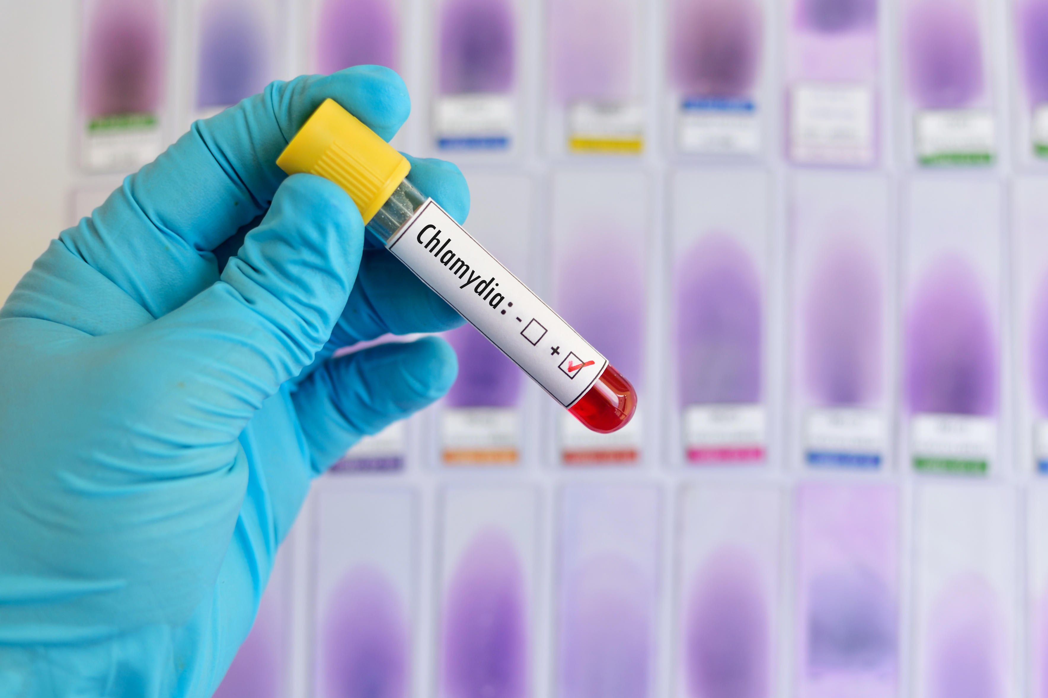 chlamydia treatment