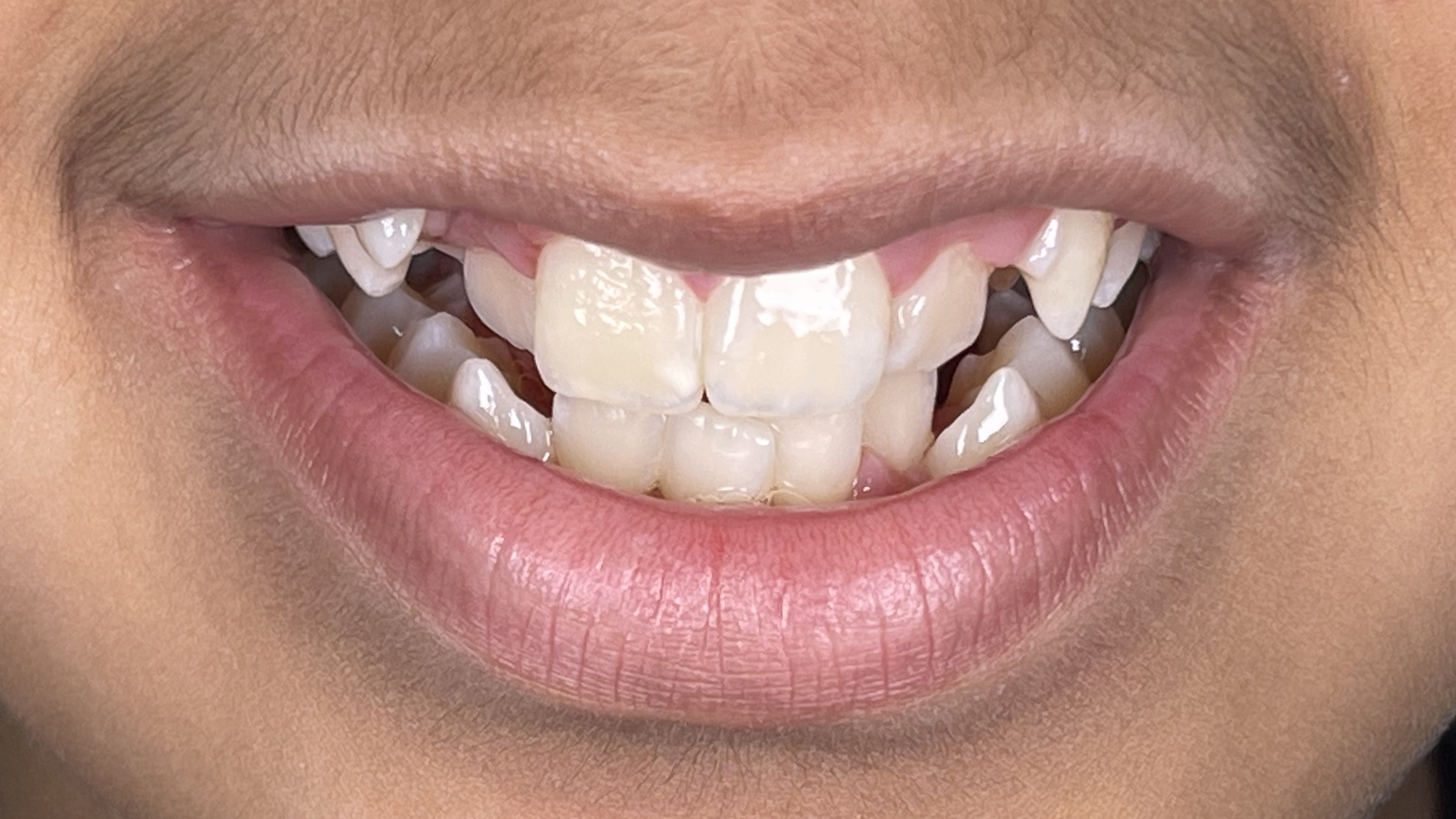 Correction of jaw protrusion
